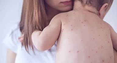 Kızamık yeniden yayılıyor: Avrupa ve Orta Asya’da vakalar yüzde 47 arttı